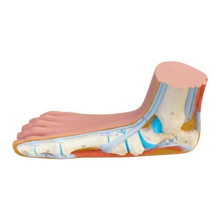 Fabrication Enterprises 3B Anatomical Model - Flat Foot (Pes Panus) 1061001